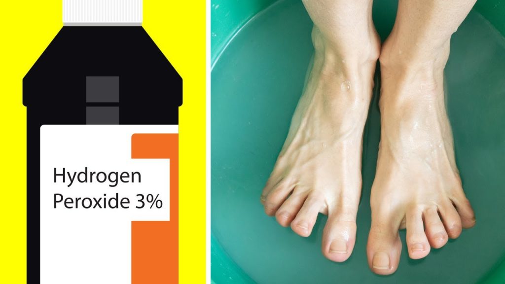 hydrogen peroxide for psoriasis healing feet